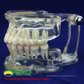 DENTAL11 (12571) Humano Adulto Natural Tamanho Transparente Padrão Dental Ensinar Modelos